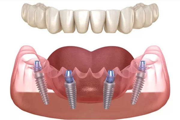 Зубний ряд із цирконію для протезування на імплантах (все на 4-ох)