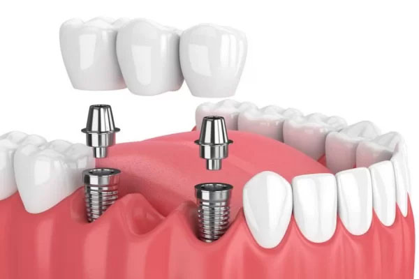 Dantų tiltelis pagamintas iš cirkonio, skirtas protezavimui ant implantų