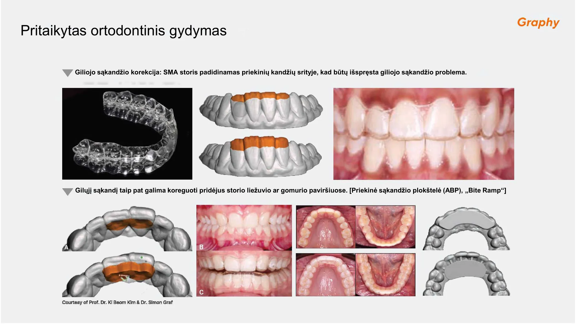 Pritaikytas ortodontinis gydymas ir Bite Ramp